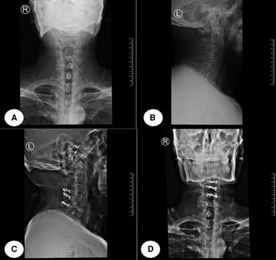 Analysis of risk factors of axial neck pain in posterior cervical single-door laminoplasty from the perspective of cervical sagittal plane